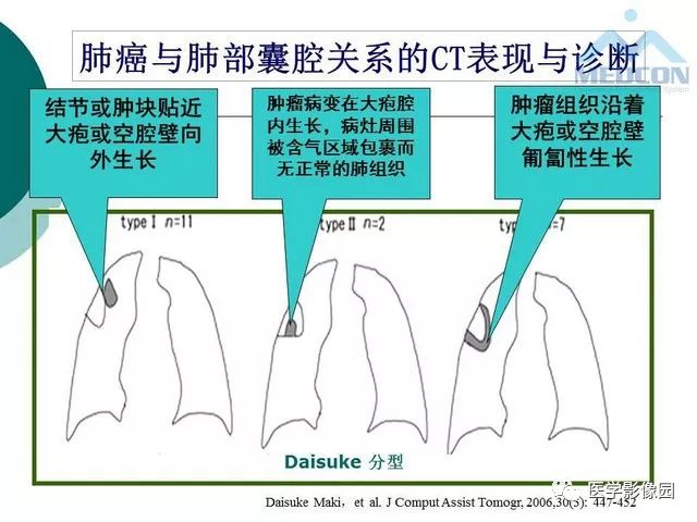 【PPT】囊性肺癌与肺癌伴空腔的CT征象诊断探讨