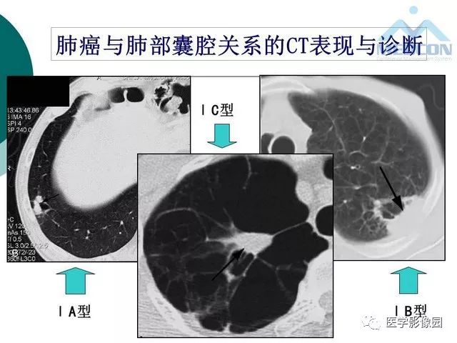 【PPT】囊性肺癌与肺癌伴空腔的CT征象诊断探讨