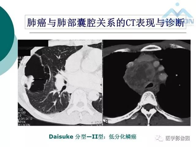 【PPT】囊性肺癌与肺癌伴空腔的CT征象诊断探讨