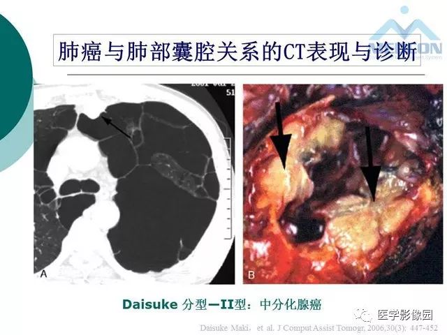 【PPT】囊性肺癌与肺癌伴空腔的CT征象诊断探讨