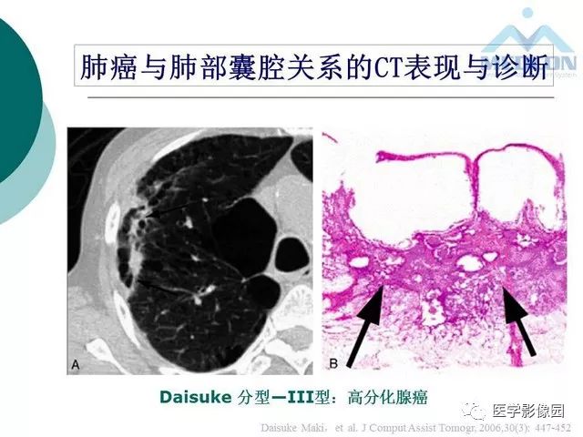 【PPT】囊性肺癌与肺癌伴空腔的CT征象诊断探讨