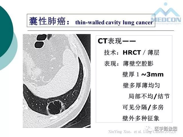 【PPT】囊性肺癌与肺癌伴空腔的CT征象诊断探讨