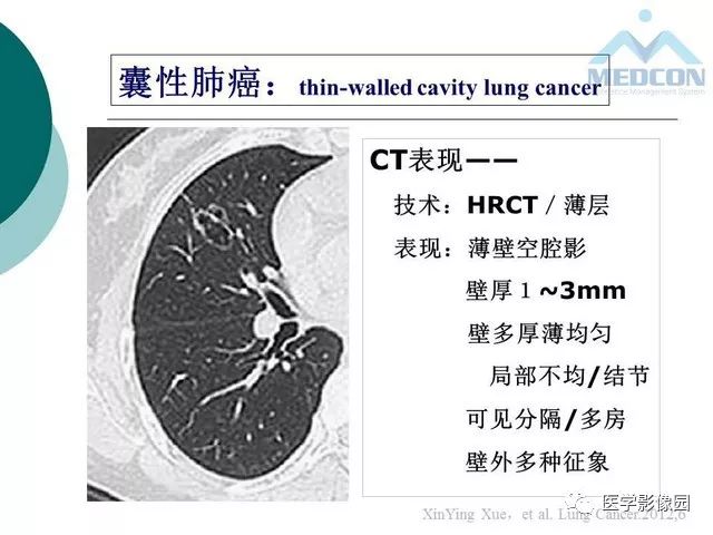 【PPT】囊性肺癌与肺癌伴空腔的CT征象诊断探讨