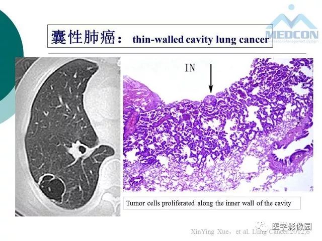 【PPT】囊性肺癌与肺癌伴空腔的CT征象诊断探讨