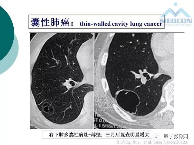 【PPT】囊性肺癌与肺癌伴空腔的CT征象诊断探讨