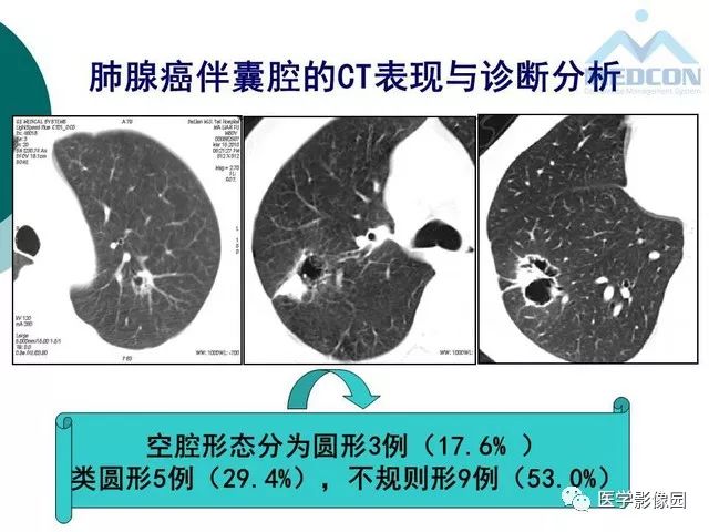 【PPT】囊性肺癌与肺癌伴空腔的CT征象诊断探讨
