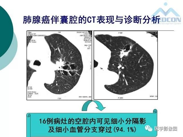 【PPT】囊性肺癌与肺癌伴空腔的CT征象诊断探讨