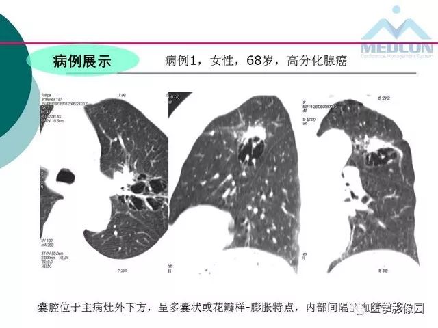 【PPT】囊性肺癌与肺癌伴空腔的CT征象诊断探讨