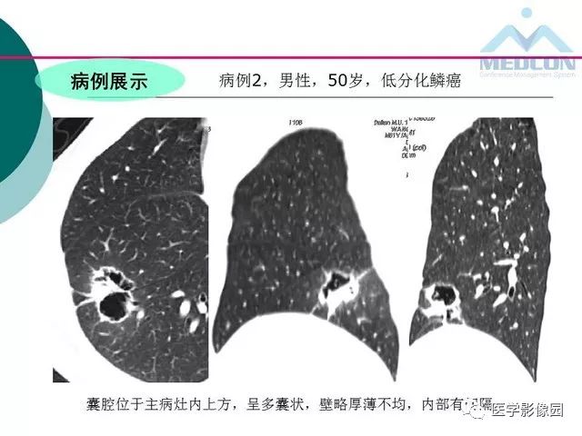 【PPT】囊性肺癌与肺癌伴空腔的CT征象诊断探讨