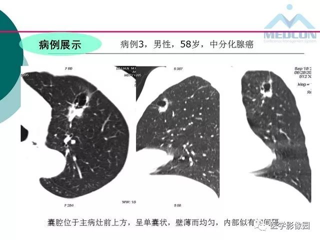 【PPT】囊性肺癌与肺癌伴空腔的CT征象诊断探讨