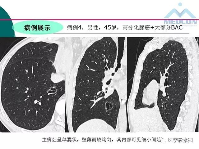 【PPT】囊性肺癌与肺癌伴空腔的CT征象诊断探讨