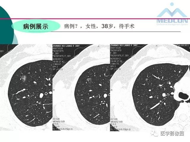 【PPT】囊性肺癌与肺癌伴空腔的CT征象诊断探讨