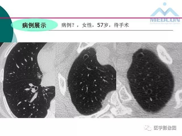 【PPT】囊性肺癌与肺癌伴空腔的CT征象诊断探讨