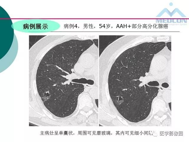 【PPT】囊性肺癌与肺癌伴空腔的CT征象诊断探讨