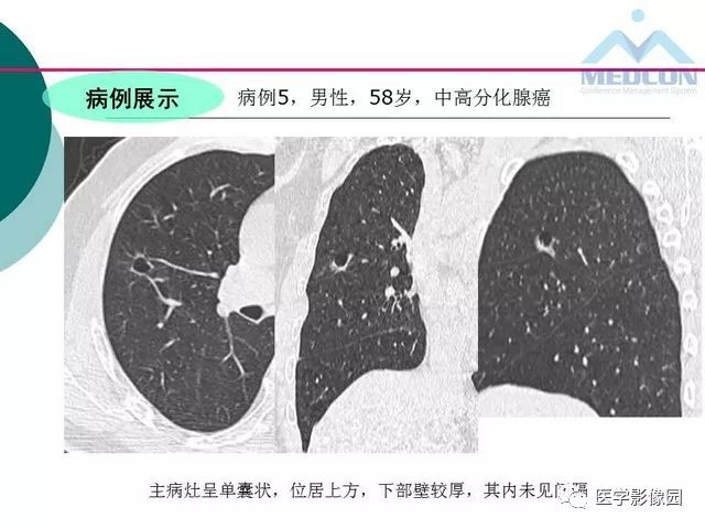 【PPT】囊性肺癌与肺癌伴空腔的CT征象诊断探讨