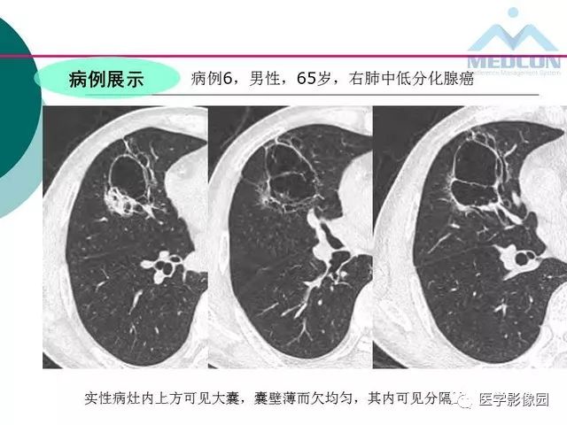 【PPT】囊性肺癌与肺癌伴空腔的CT征象诊断探讨