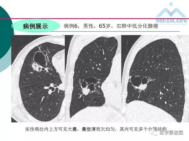 【PPT】囊性肺癌与肺癌伴空腔的CT征象诊断探讨