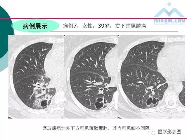【PPT】囊性肺癌与肺癌伴空腔的CT征象诊断探讨