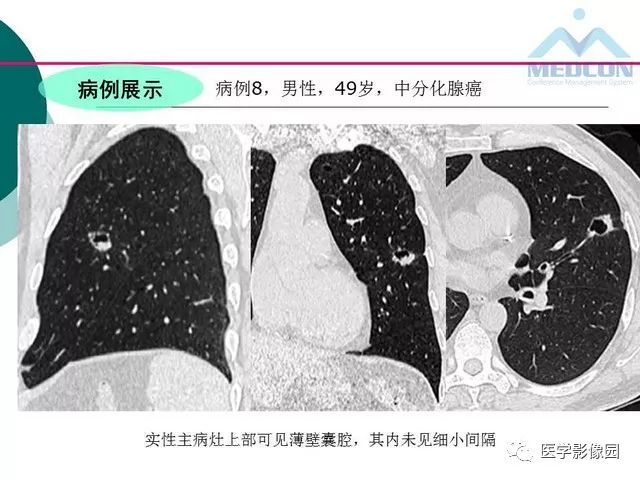 【PPT】囊性肺癌与肺癌伴空腔的CT征象诊断探讨