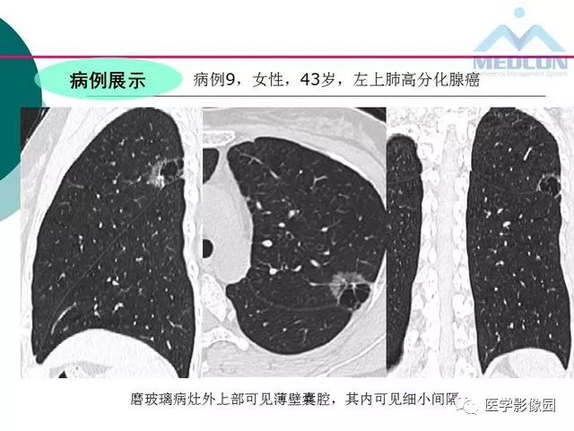 【PPT】囊性肺癌与肺癌伴空腔的CT征象诊断探讨