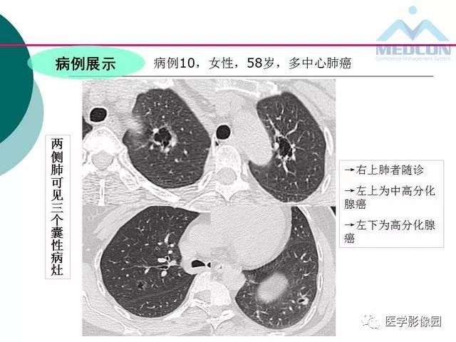 【PPT】囊性肺癌与肺癌伴空腔的CT征象诊断探讨