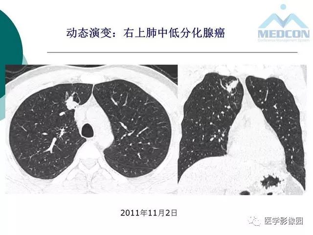 【PPT】囊性肺癌与肺癌伴空腔的CT征象诊断探讨