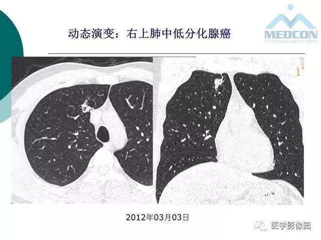 【PPT】囊性肺癌与肺癌伴空腔的CT征象诊断探讨