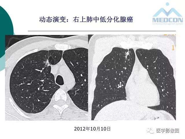 【PPT】囊性肺癌与肺癌伴空腔的CT征象诊断探讨