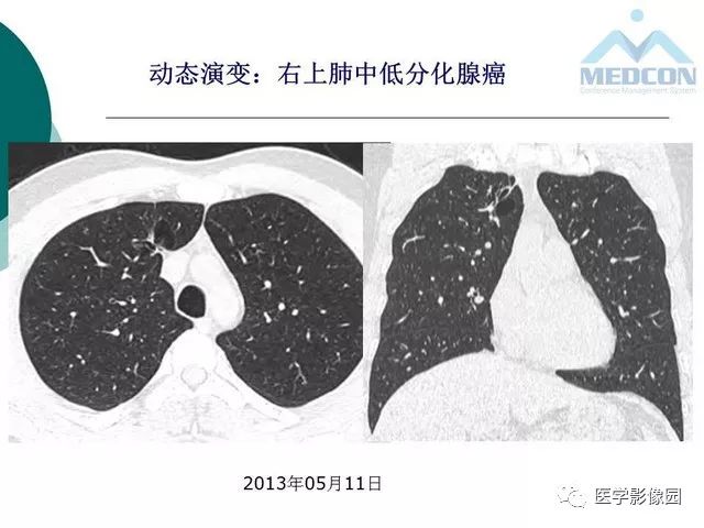 【PPT】囊性肺癌与肺癌伴空腔的CT征象诊断探讨