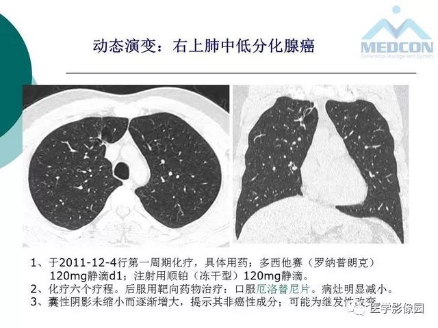 【PPT】囊性肺癌与肺癌伴空腔的CT征象诊断探讨