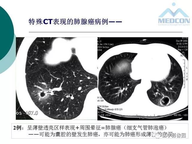 【PPT】囊性肺癌与肺癌伴空腔的CT征象诊断探讨