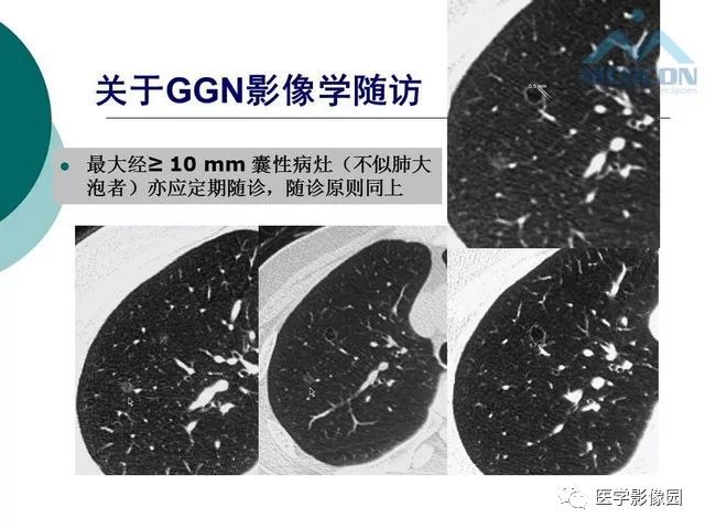【PPT】囊性肺癌与肺癌伴空腔的CT征象诊断探讨