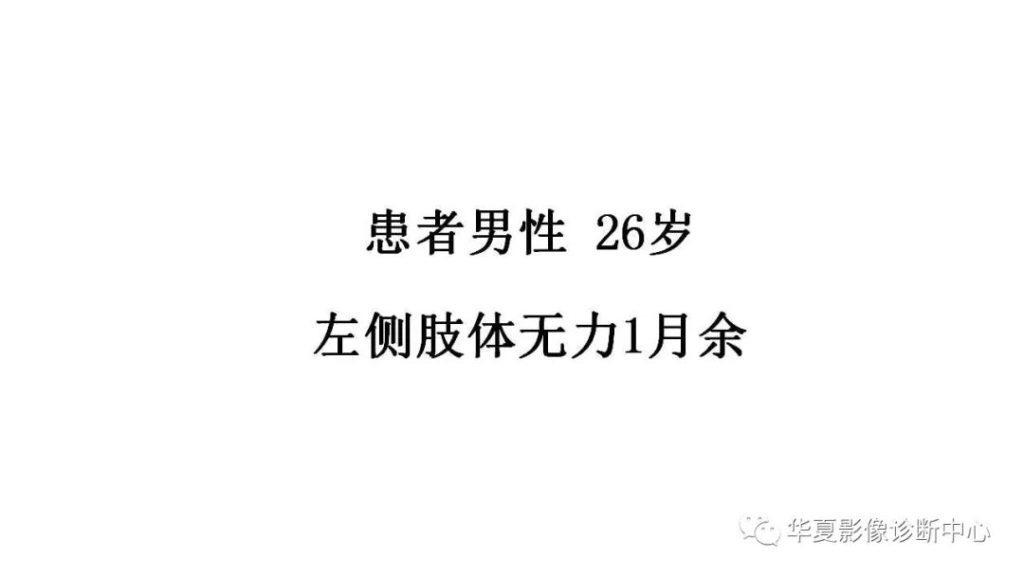 【病例】鞍旁脊索瘤1例CT及MR