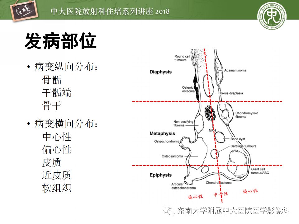【PPT】骨肿瘤及类肿瘤病变的影像诊断思路