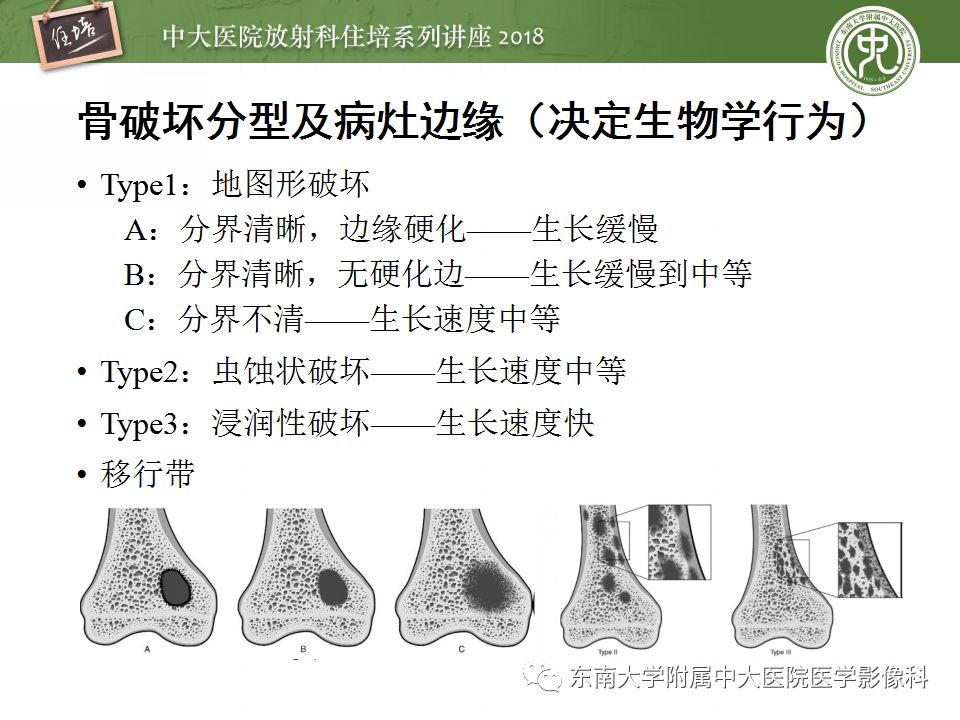 【PPT】骨肿瘤及类肿瘤病变的影像诊断思路