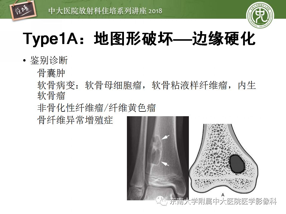 【PPT】骨肿瘤及类肿瘤病变的影像诊断思路