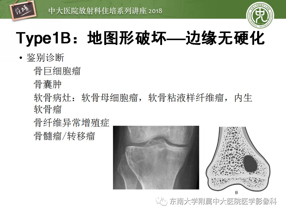 【PPT】骨肿瘤及类肿瘤病变的影像诊断思路