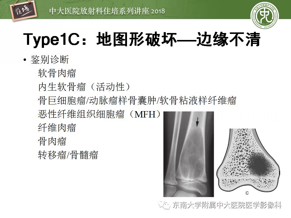【PPT】骨肿瘤及类肿瘤病变的影像诊断思路