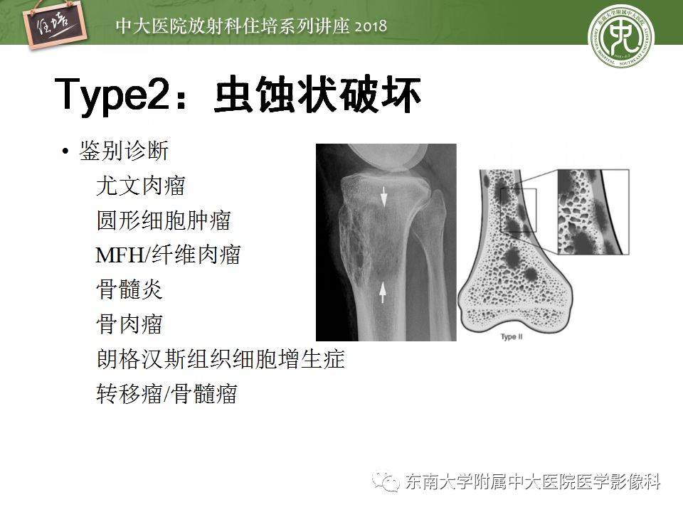 【PPT】骨肿瘤及类肿瘤病变的影像诊断思路