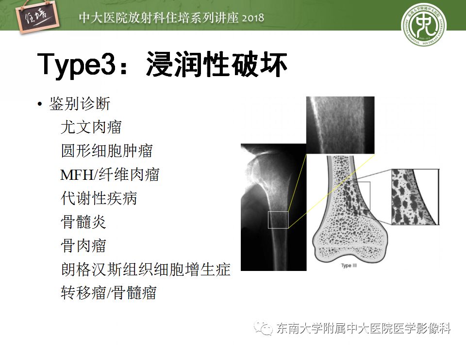 【PPT】骨肿瘤及类肿瘤病变的影像诊断思路