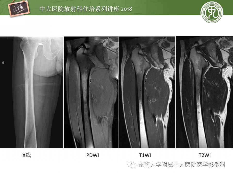 【PPT】骨肿瘤及类肿瘤病变的影像诊断思路
