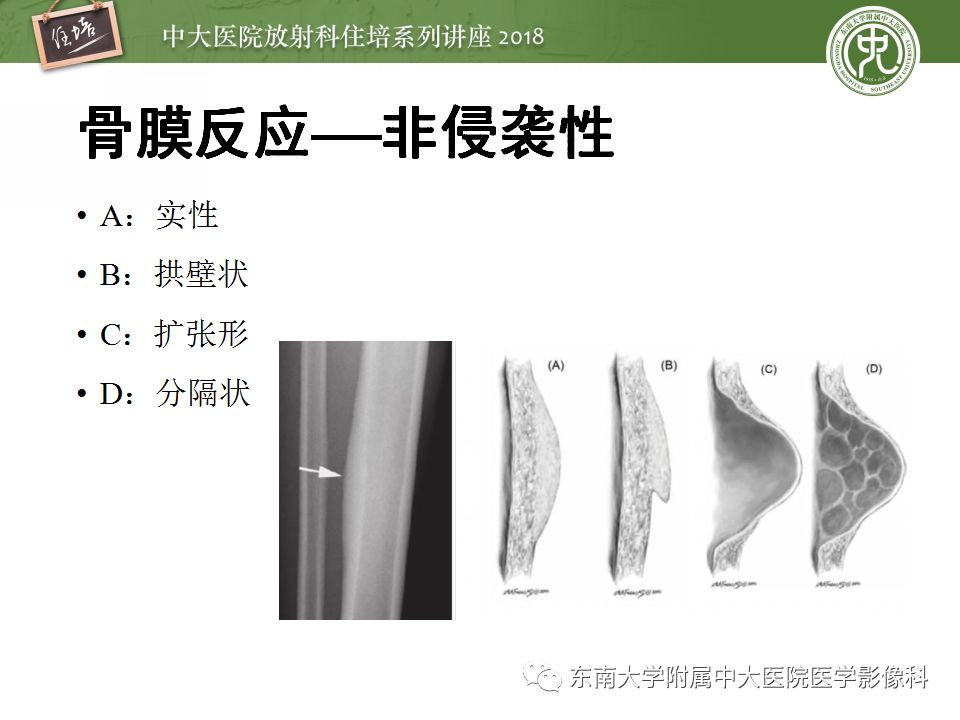 【PPT】骨肿瘤及类肿瘤病变的影像诊断思路