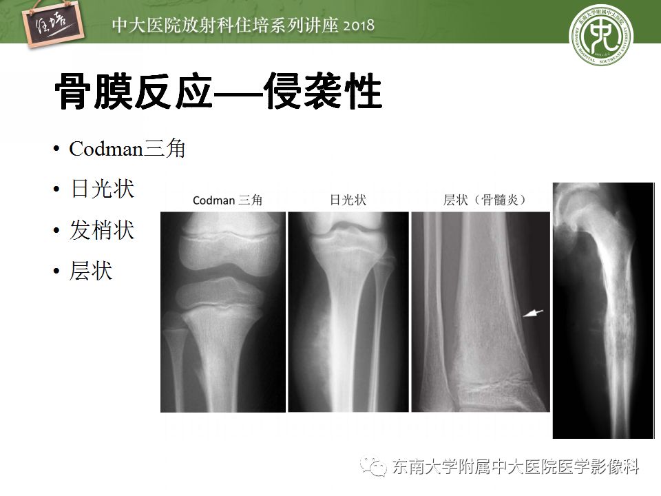 【PPT】骨肿瘤及类肿瘤病变的影像诊断思路