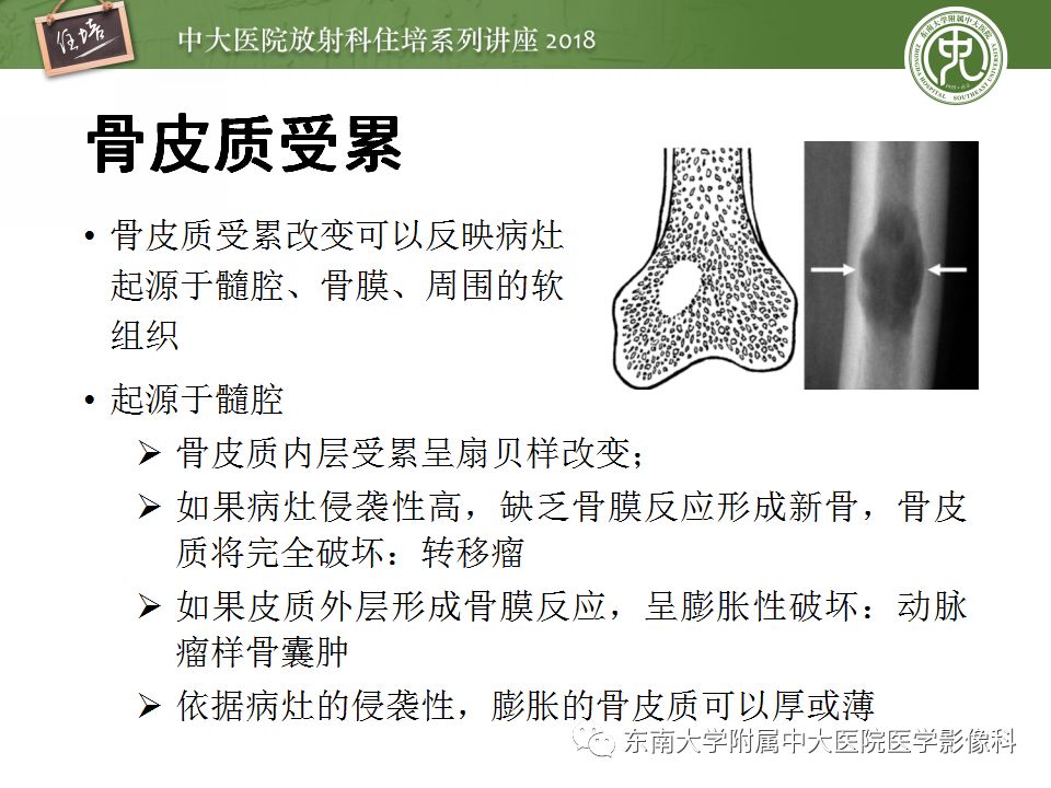 【PPT】骨肿瘤及类肿瘤病变的影像诊断思路