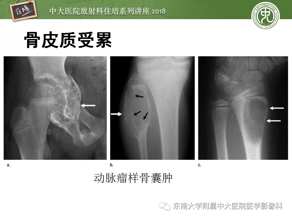【PPT】骨肿瘤及类肿瘤病变的影像诊断思路