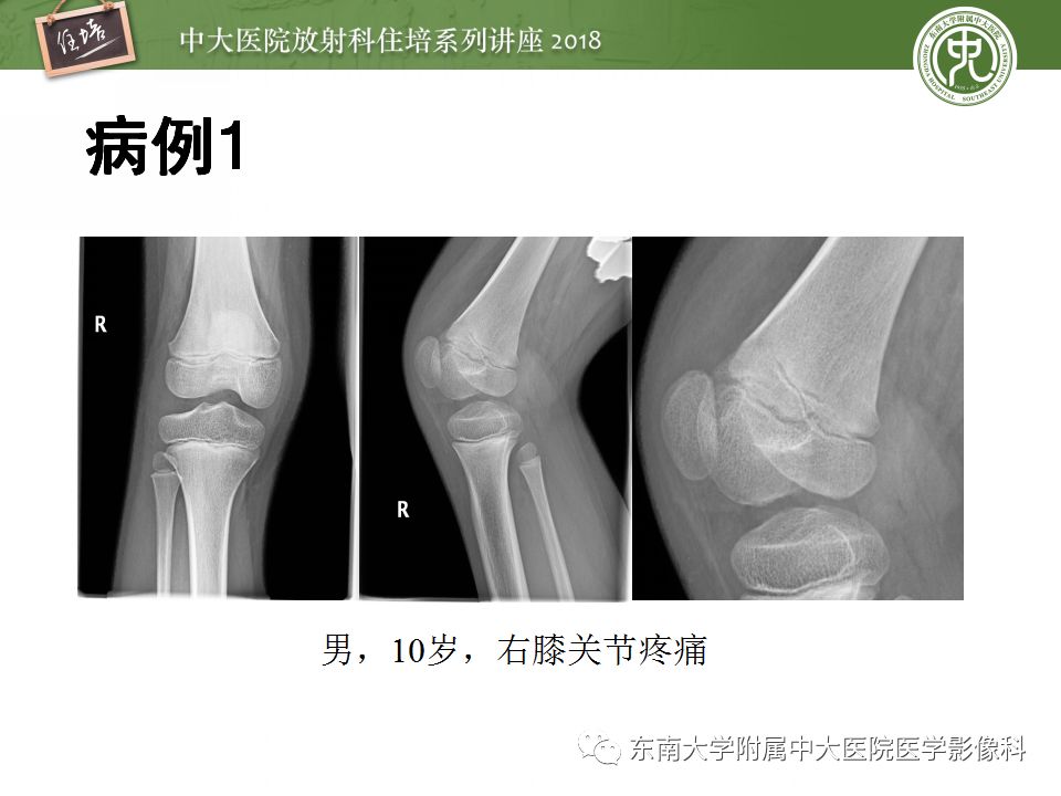 【PPT】骨肿瘤及类肿瘤病变的影像诊断思路