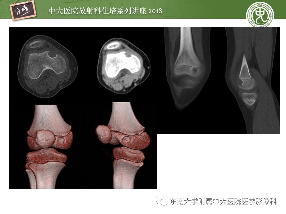 【PPT】骨肿瘤及类肿瘤病变的影像诊断思路