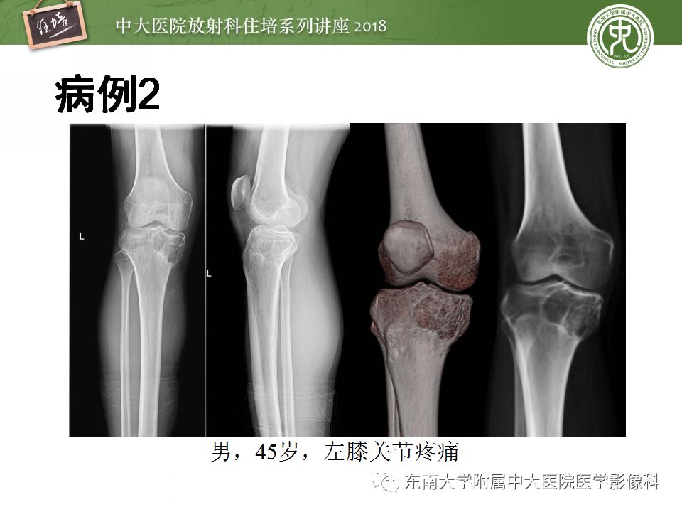 【PPT】骨肿瘤及类肿瘤病变的影像诊断思路