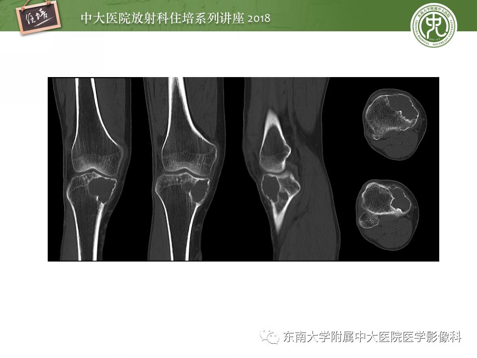 【PPT】骨肿瘤及类肿瘤病变的影像诊断思路