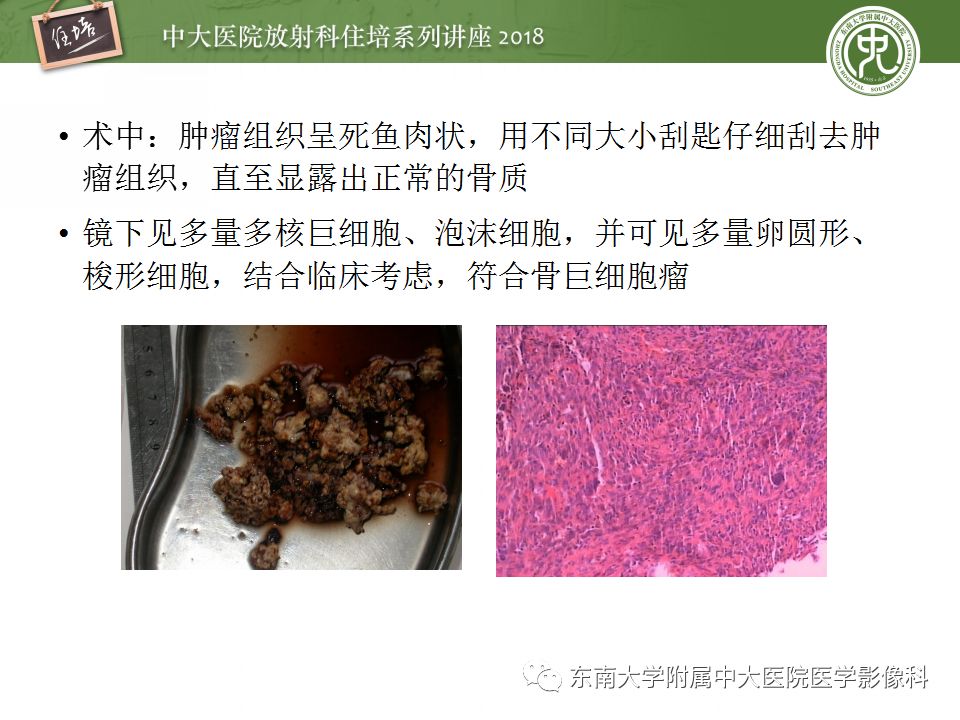 【PPT】骨肿瘤及类肿瘤病变的影像诊断思路